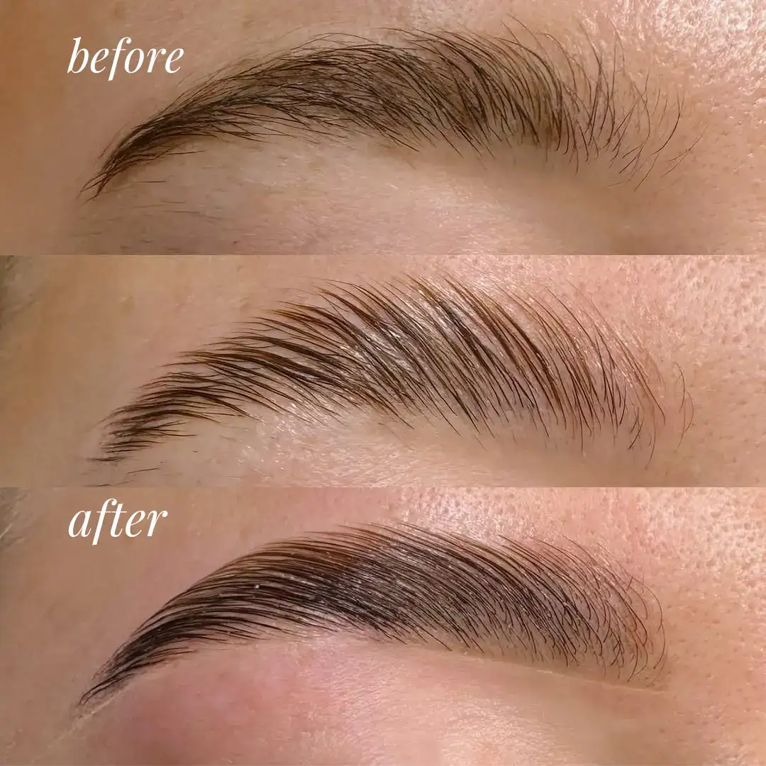 Before and after image of subtle facial rejuvenation treatment