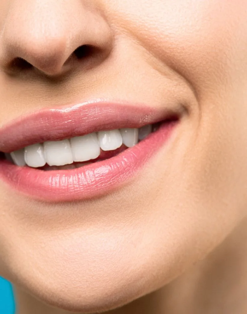 A natural, confident smile finished with porcelain veneers